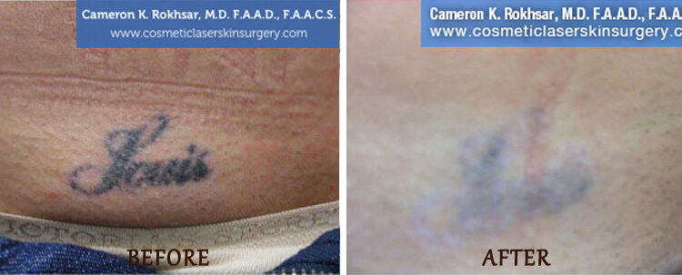 Tattoo Removal: Before and After Treatment Photo - patient 3