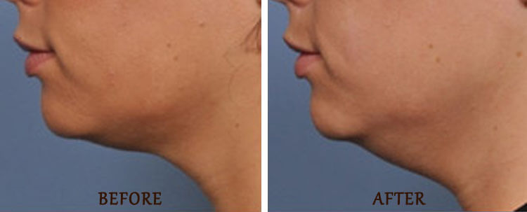 Ultherapy: Before and After Treatment Photo - patient 2