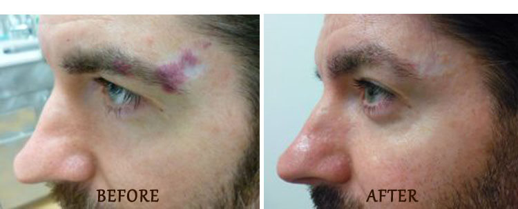 V-Beam: Before and After Treatment Photo - patient 1