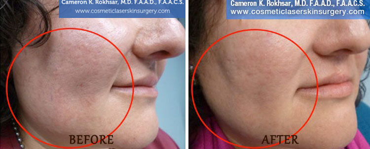 V-Beam: Before and After Treatment Photo - patient 2