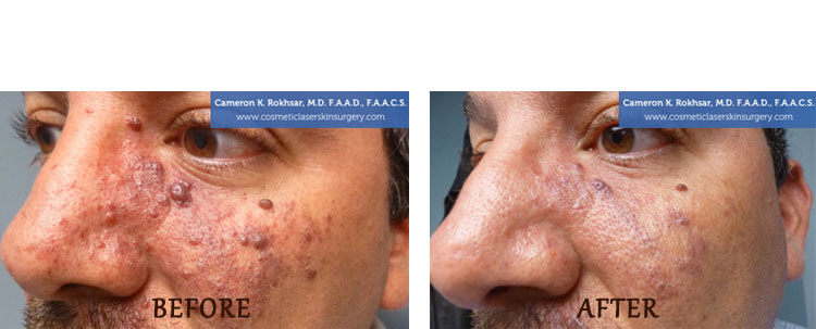 V-Beam: Before and After Treatment Photo - patient 3