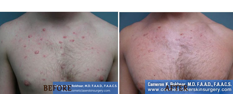 V-Beam: Before and After Treatment Photo - patient 4