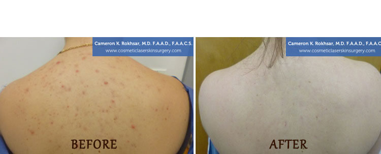 V-Beam: Before and After Treatment Photo - patient 5