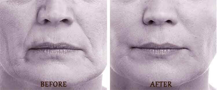 Volbella: Before and After Treatment Photo - patient 2