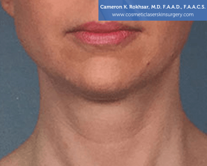 Woman's face, After Kybella Treatment - front view, patient 2
