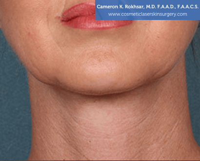 Woman's face, After Kybella Treatment - front view, patient 1