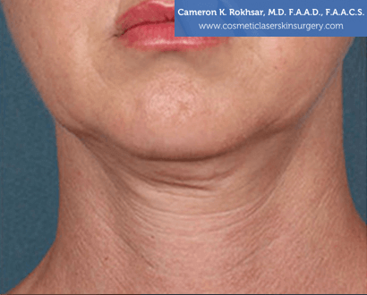 Woman's face, Before Kybella Treatment - front view, patient 1