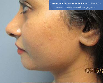 Woman's face, Before Chin Job Treatment - left side view, patient 1
