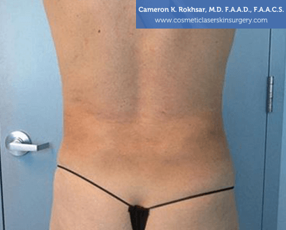 Woman's back, After Liposuction Treatment - back view, patient 2