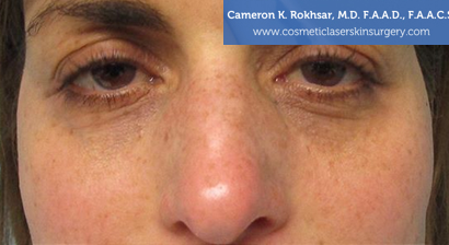 Woman's face, Before Non Surgical Eyelift Treatment - front view, patient 3