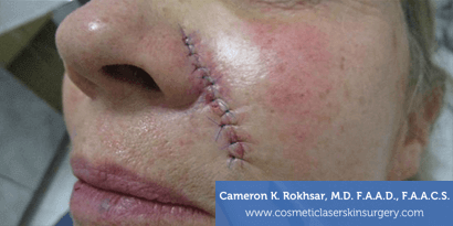 Woman's face, After Mohs Surgery Treatment - cheek, oblique view, patient 1