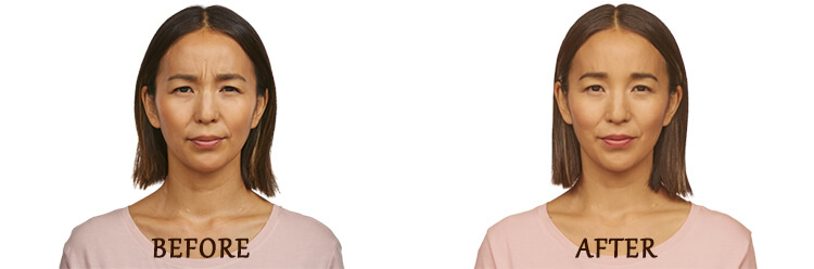 Before & After Jeuveau Treatment Photo - Female face, front view, patient 1