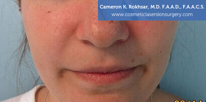 Woman's face, Before Lip Enhancement Treatment - lips, front view, patient 1