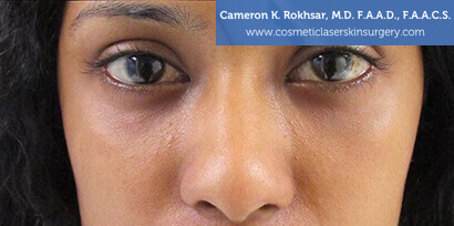 Non-Surgical Eyelift Before and After Photos • Dr. Cameron Rokhsar