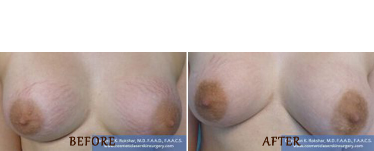 Stretch Marks: Before and After Treatment Photo - patient 1