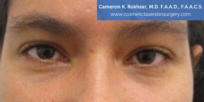 Woman's eyes, Before Fillers Treatment - front view, patient 1