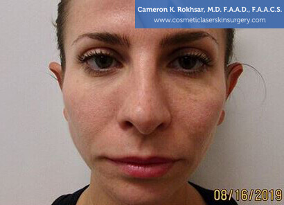 Woman's face, Before Non Surgical Eyelift Treatment - front view, patient 1