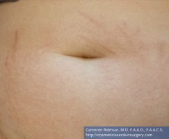 Woman's tummy, After Stretch Marks Treatment - patient 1
