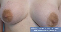 Woman's brests, After Stretch Marks Treatment - front view, patient 2