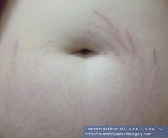 Woman's tummy Before Stretch Marks Treatment - patient 1