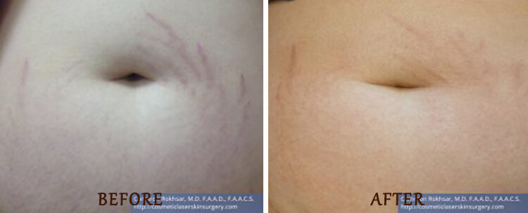 Stretch Marks: Before and After Treatment Photo - patient 2