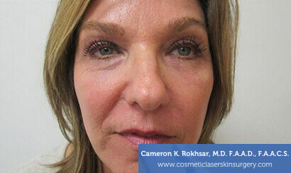 Woman's face, After Fraxel Treatment photo, front view, patient 2