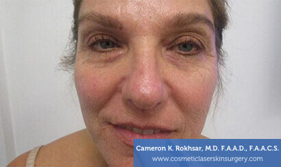 Woman's face, Before Fraxel Treatment photo, front view, patient 2