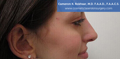 Non Surgical Nosejob After Treatment Photo - Female, side view, patient 3