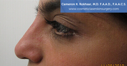 Non Surgical Nosejob Before Treatment Photo - Female, side view, patient 4