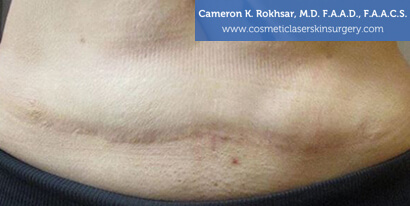 Female tummy, After Scar Revisions Treatment, front view, patient 1