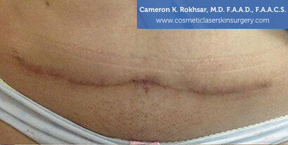 Female tummy, before Scar Revisions Treatment, front view, patient 1