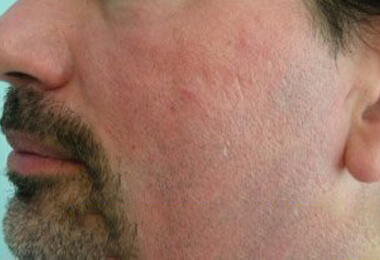 Fraxel Laser - After treatment photo, patient 6