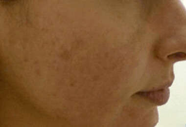 Fraxel Laser - After treatment photo, patient 7