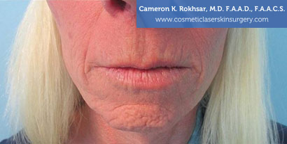 Woman's lips, After Fraxel Treatment photo, front view, patient 4