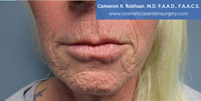 Woman's lips, Before Fraxel Treatment photo, front view, patient 4