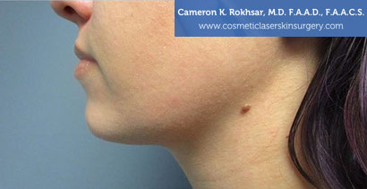 Female face, After Kybella Treatment, side view, patient 1