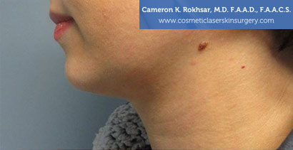 Female face, Before Kybella Treatment, side view, patient 1