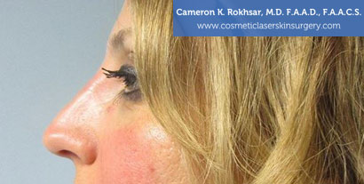 Non Surgical Nosejob After Treatment Photo - Female, side view, patient 6