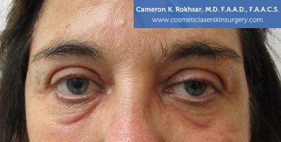 Female face, After Blepharoplasty Treatment, front view, patient 1