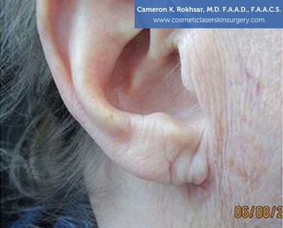 Female Earlobes, After Treatment photo, side view, patient 2