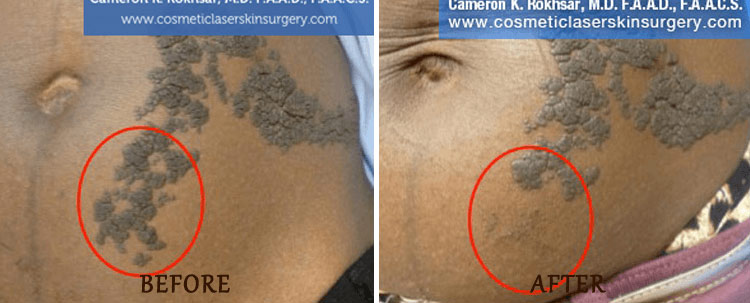 Birthmark Removal: Before and After Treatment Photo - patient 4