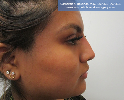 Non Surgical Nosejob After Treatment Photo - Female, side view, patient 8