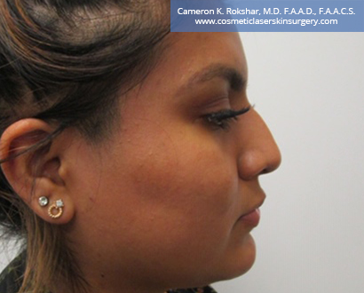 Non Surgical Nosejob Before Treatment Photo - Female, side view, patient 8