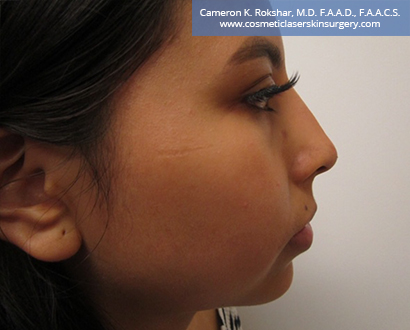 Non Surgical Nosejob After Treatment Photo - Female, side view, patient 9