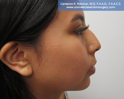 Non Surgical Nosejob Before Treatment Photo - Female, side view, patient 9