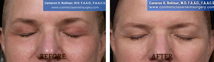 Fraxel: Before and After Treatment Photo - patient 13