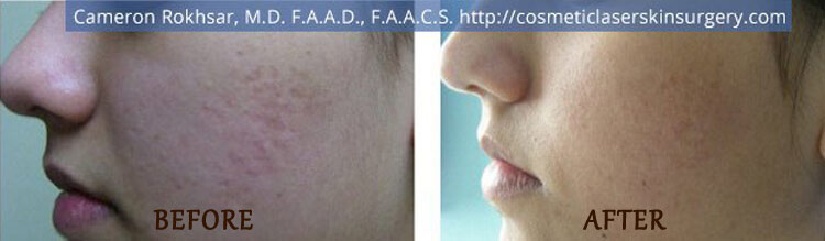 Fraxel: Before and After Treatment Photo - patient 8