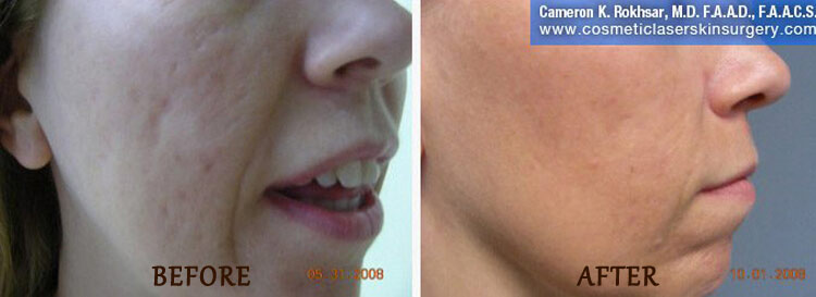 Fraxel: Before and After Treatment Photo - patient 9