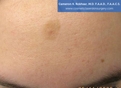 Patient face, Photo - After Birthmarks Treatment, front view, patient 1