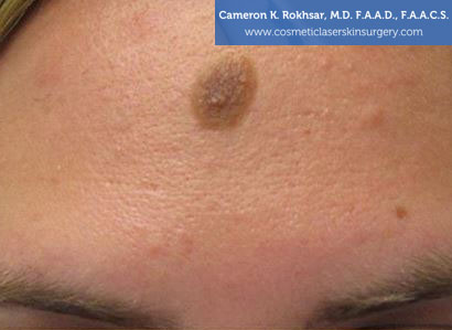 Patient face, Photo - Before Birthmarks Treatment, front view, patient 1